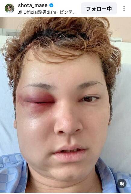Handsome actor Shota Mase, who suffered from a rare disease affecting 1 in 100,000 people, has surprised everyone with his current appearance seven years after facial collapse, saying, "My face," and "It's heartbreaking," as he struggles with aftereffects.