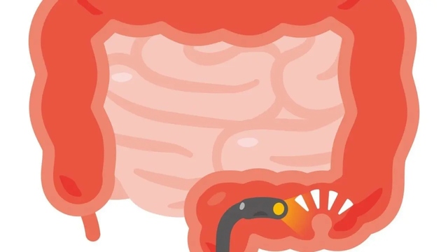 Characteristics of people who are prone to developing "colorectal polyps," along with the risks of "cancer" and the treatment process, are explained by a doctor.