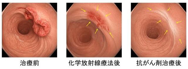 The Option of Not Having Surgery for Advanced Rectal Cancer [A Colorectal Surgeon Talks About Colorectal Cancer]