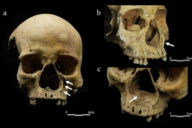 A 'phantom punishment' found only in ancient Chinese texts: first evidence from human bones?