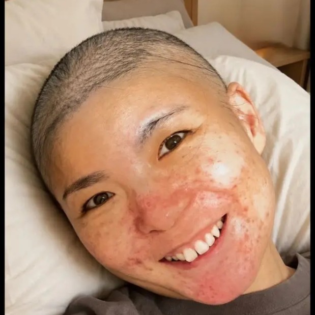[Illness journey] The true identity of the fatigue after returning from childcare leave was 'rectal cancer'—an artificial anus, and after surgery, peritoneal dissemination with 'half a year to live'